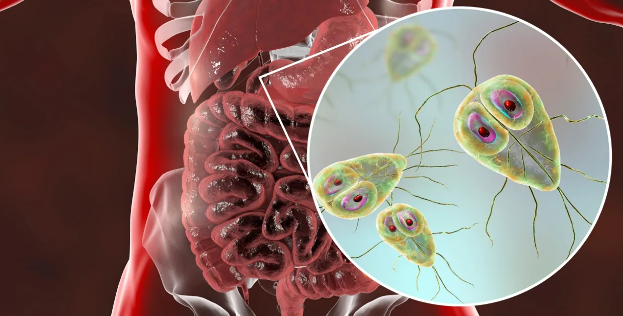 Giardiasis